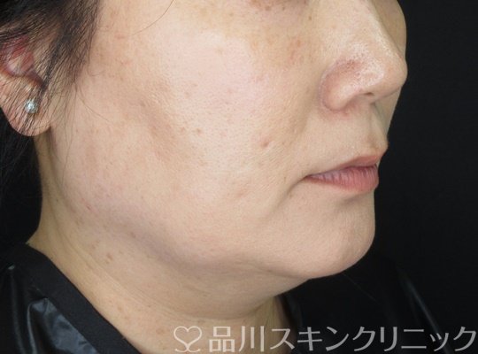 症例NO.70217のAFTER写真