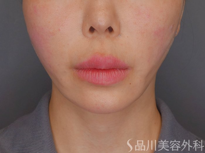 症例NO.72145のAFTER写真