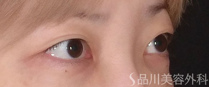 症例NO.70574のBEFORE写真