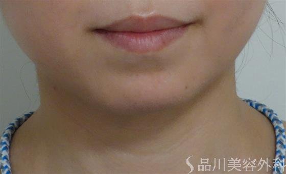 症例NO.55828のBEFORE写真