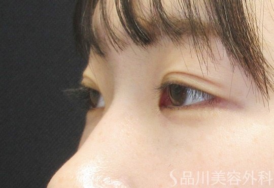 症例NO.69552のAFTER写真