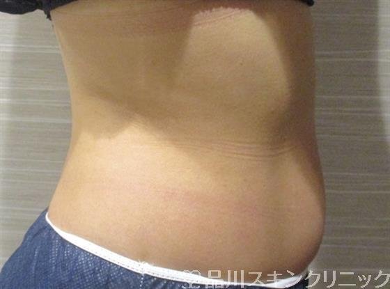 症例NO.36221のBEFORE写真
