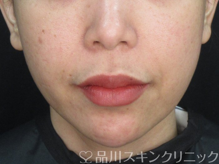 症例NO.73806のBEFORE写真