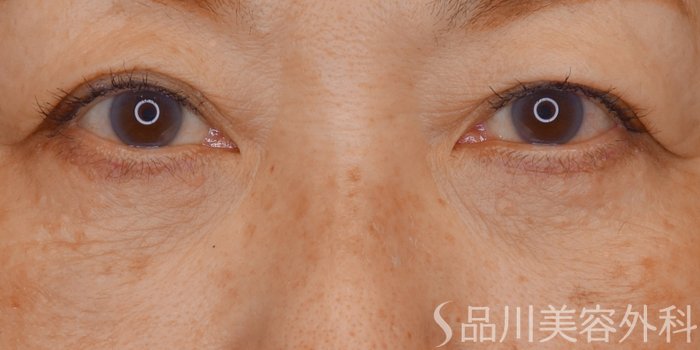 症例NO.72302のAFTER写真