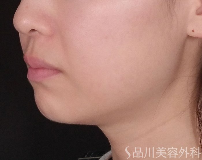 症例NO.74338のBEFORE写真