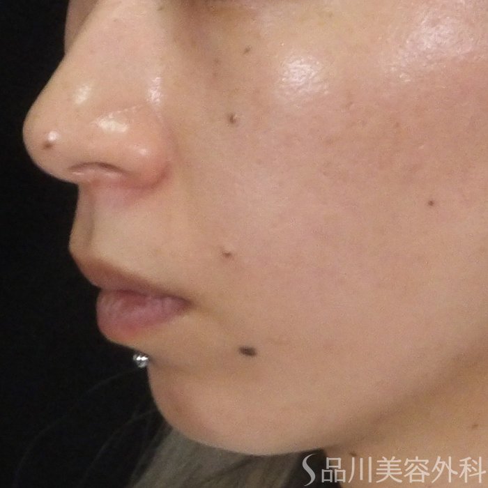 症例NO.69234のBEFORE写真
