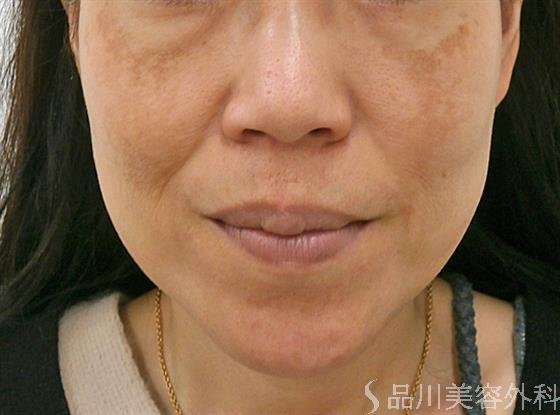 症例NO.32242のBEFORE写真