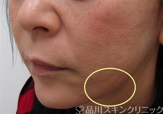 症例NO.34502のAFTER写真