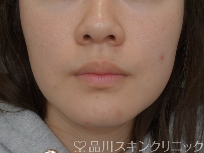 症例NO.73671のBEFORE写真