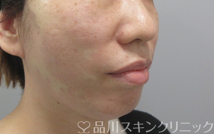 症例NO.70003のAFTER写真