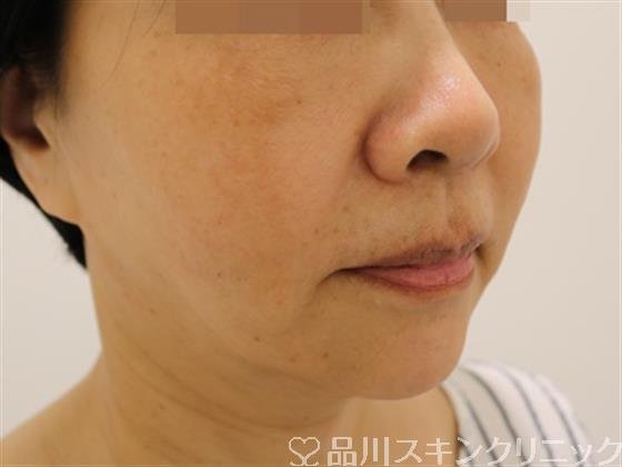症例NO.41707のAFTER写真