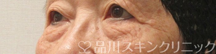 症例NO.75343のBEFORE写真