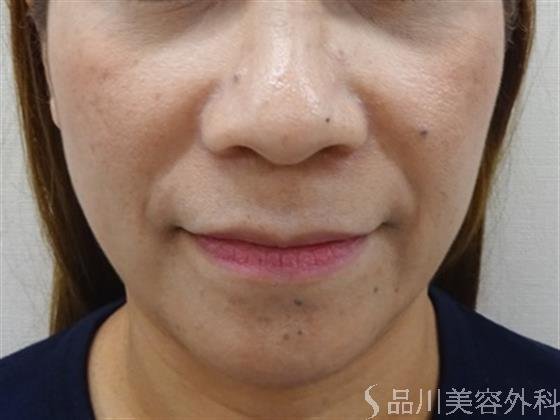 症例NO.40933のBEFORE写真