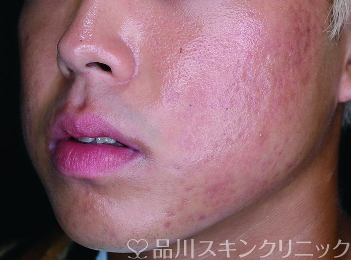 症例NO.73705のAFTER写真