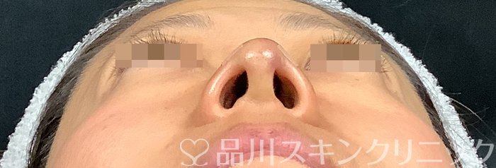 症例NO.67914のAFTER写真