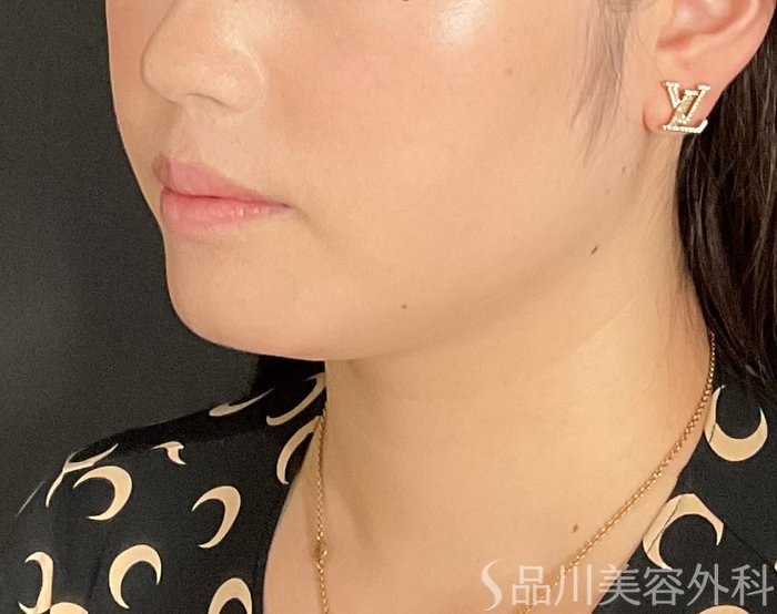 症例NO.74823のBEFORE写真