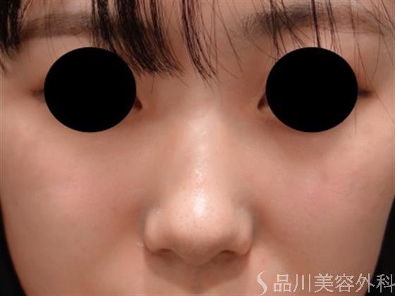 症例NO.50301のBEFORE写真