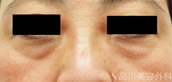 症例NO.39676のBEFORE写真