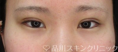 症例NO.70298のAFTER写真