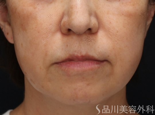 症例NO.72705のBEFORE写真
