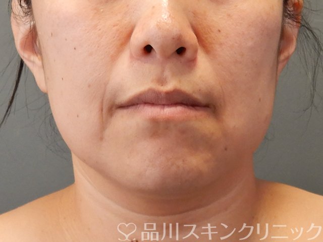 症例NO.75062のBEFORE写真