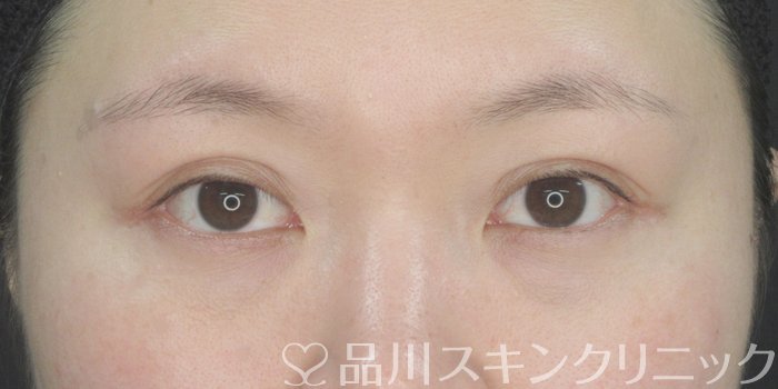 症例NO.70572のAFTER写真