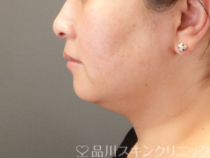 症例NO.63669のBEFORE写真