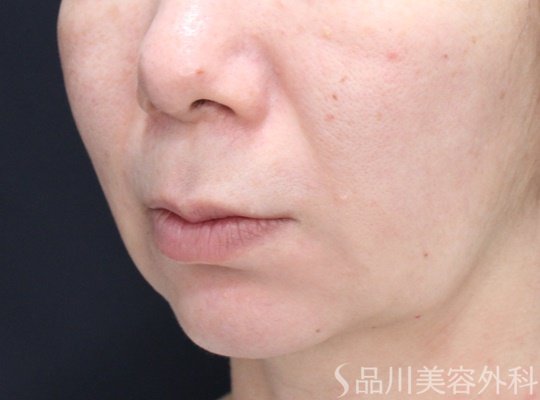 症例NO.69969のBEFORE写真