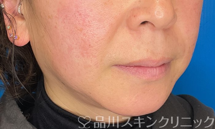 症例NO.74509のBEFORE写真
