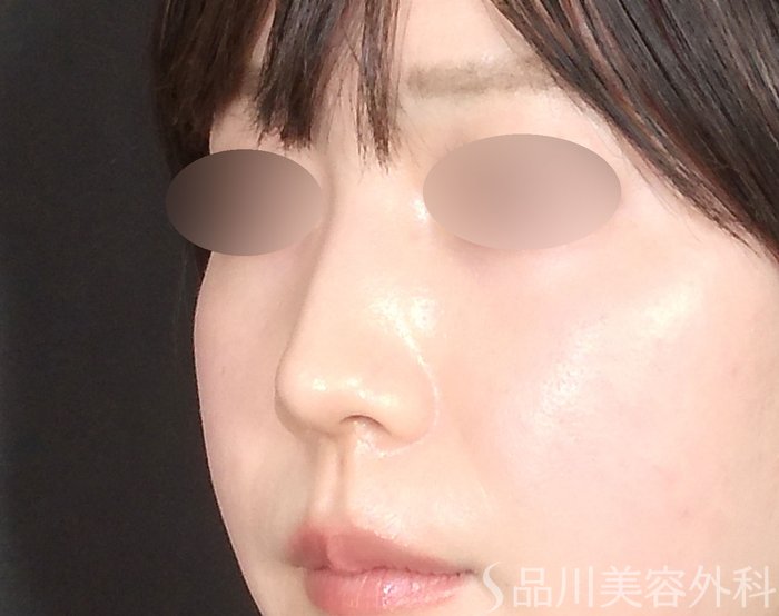 症例NO.71999のBEFORE写真