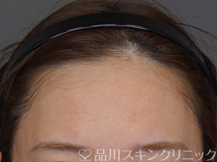 症例NO.74120のBEFORE写真