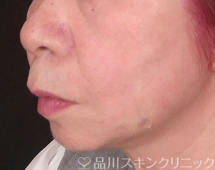 症例NO.69742のAFTER写真