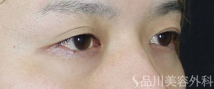 症例NO.71972のBEFORE写真