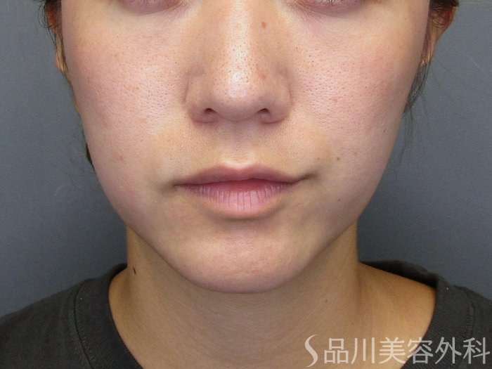 症例NO.75194のBEFORE写真