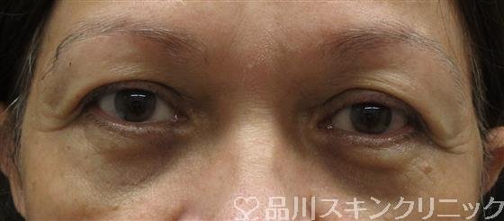 症例NO.61028のAFTER写真