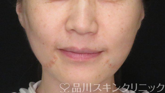 症例NO.70963のAFTER写真