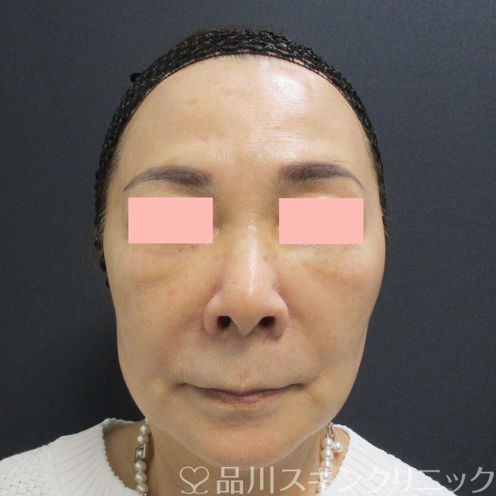 症例NO.69760のAFTER写真