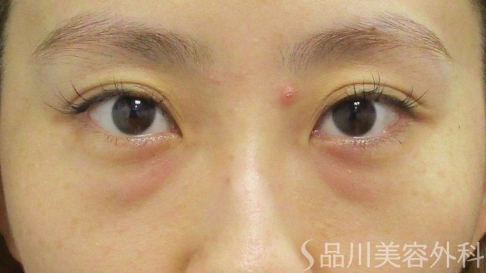 症例NO.73243のBEFORE写真