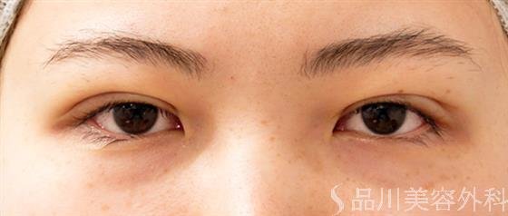 症例NO.55242のAFTER写真