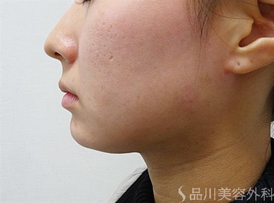 症例NO.53255のAFTER写真