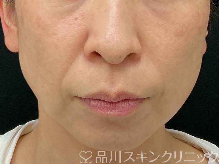 症例NO.74844のBEFORE写真