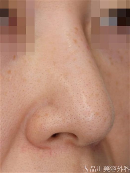 症例NO.51357のBEFORE写真