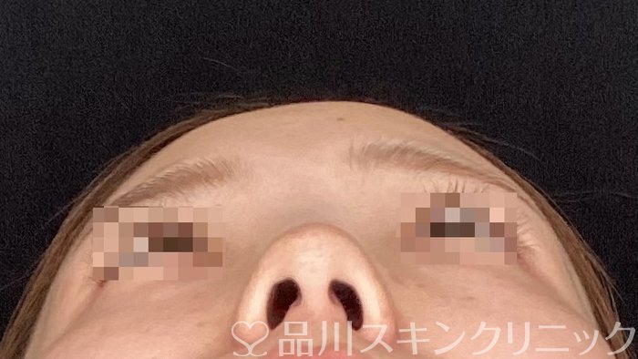 症例NO.64649のBEFORE写真