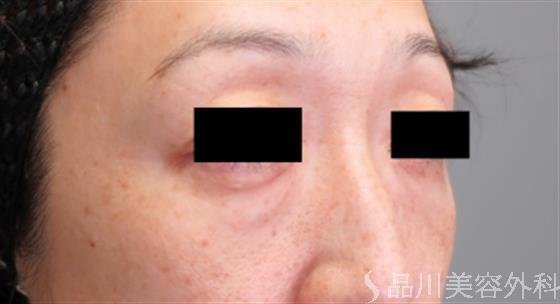 症例NO.47840のBEFORE写真