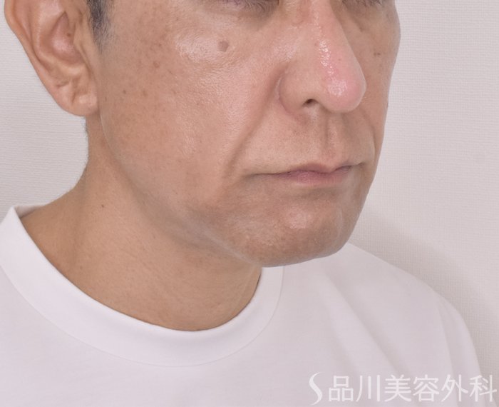 症例NO.66043のBEFORE写真