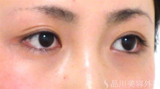 症例NO.27048のBEFORE写真