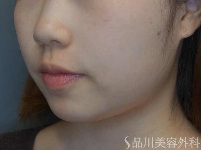 症例NO.73909のAFTER写真