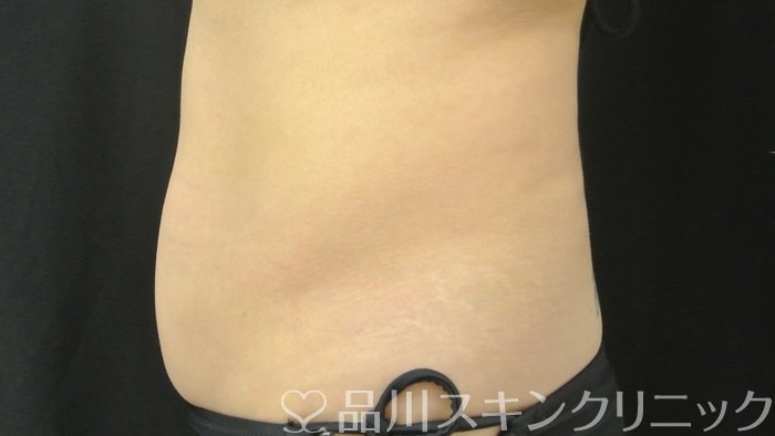 症例NO.70814のAFTER写真