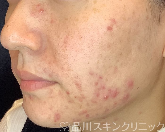 症例NO.69780のBEFORE写真