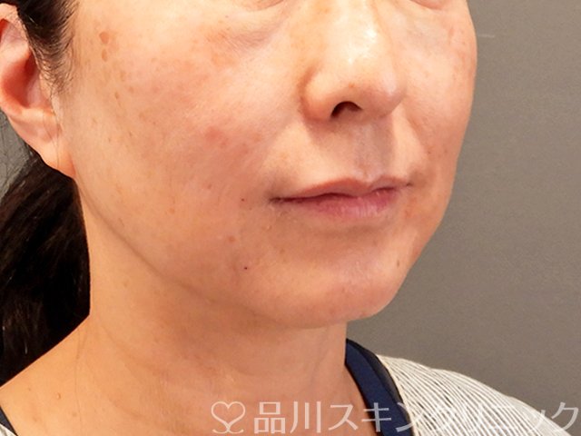 症例NO.70433のAFTER写真